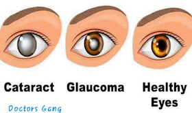 Cataract :type, cause, symptoms, treatment 